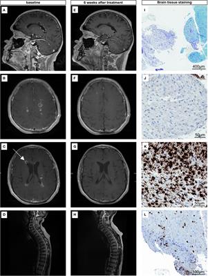 Case Report: Pseudomeningeosis and Demyelinating Metastasis-Like Lesions From Checkpoint Inhibitor Therapy in Malignant Melanoma